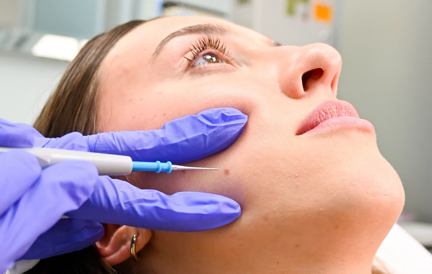 The electrocautery tip at a small mole on a client’s face