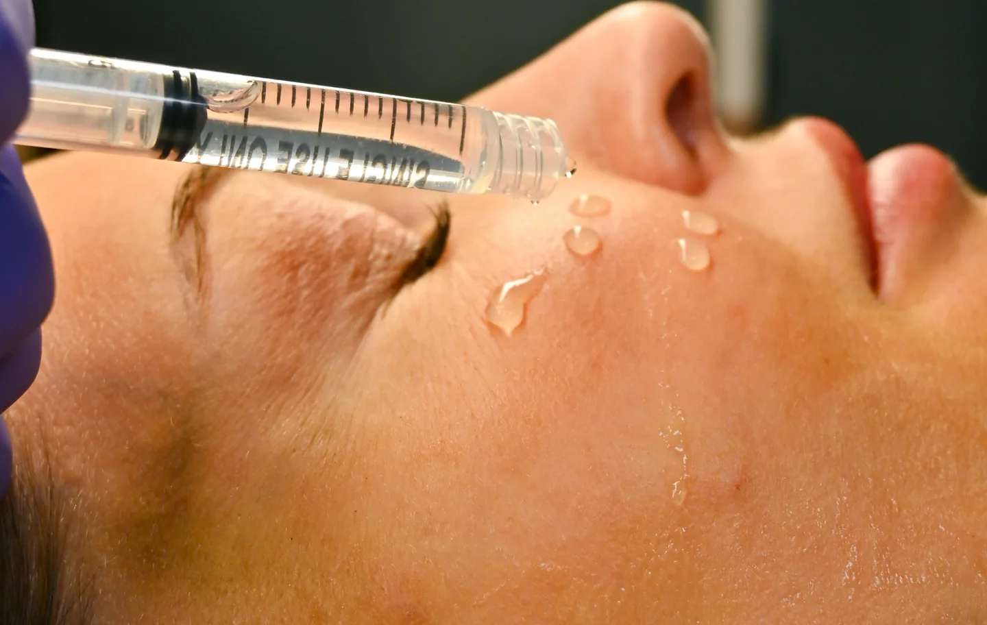 Serum dropped onto the cheek from a needle-free syringe
