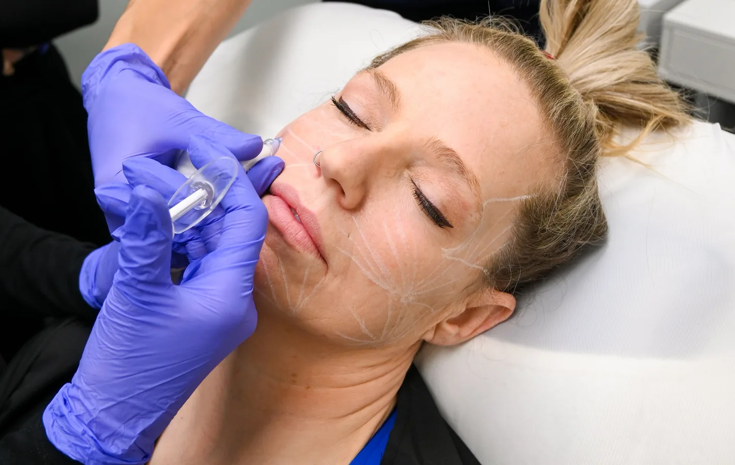 A biostimulator placed along the lower face, the plan drawn on the skin