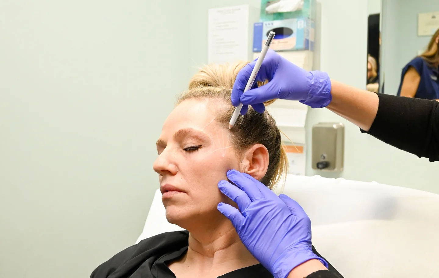 An injector marking the cheek and jawline before a thread lift