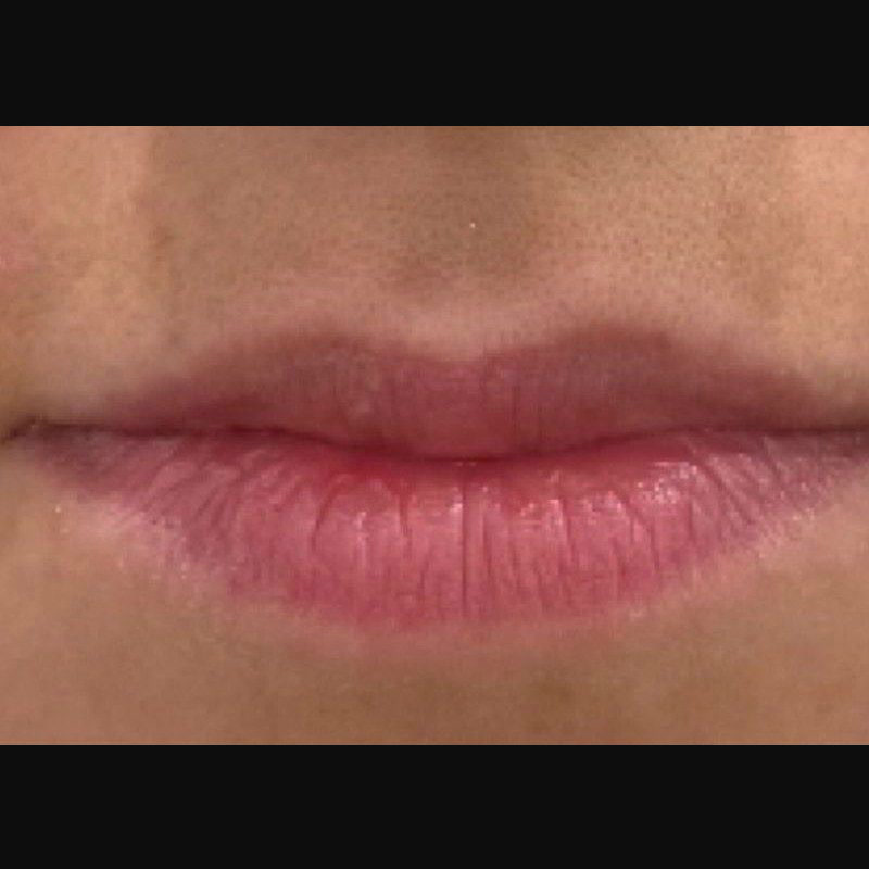 Before treatment