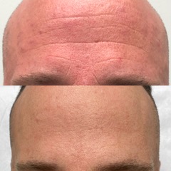 picture of a forehead