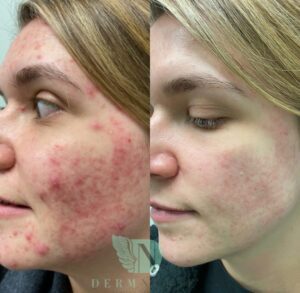 DermNurse Medical Aesthetics acne treatment on a patient